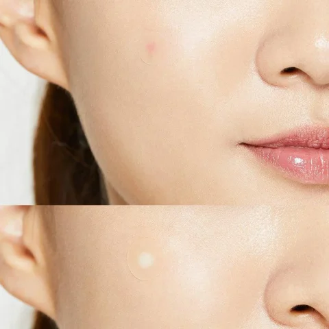 Acne Pimple Master Patch_1